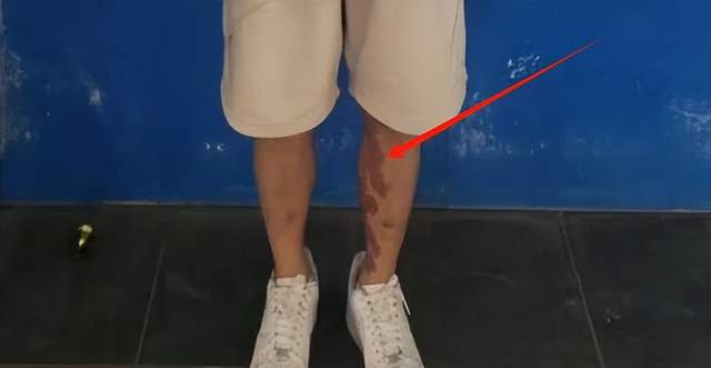 星全身照腿部伤痕惊心更多受害家属发声m6米乐app营救神速！泰方公布星(图6)